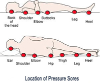 Location of pressure sores