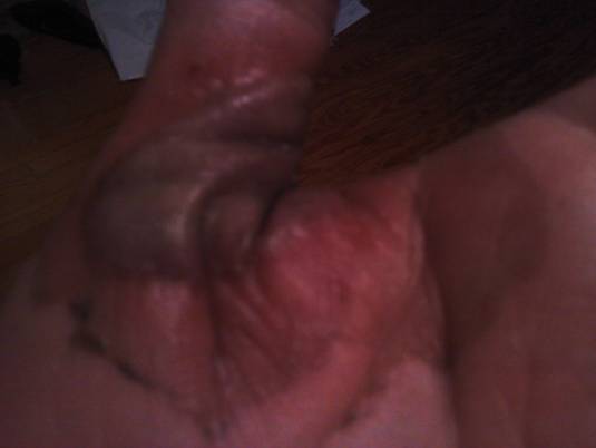 Hydrchloric acid burn before clay.jpg