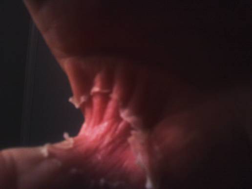 Hydrochloric acid burn after 4 days of clay.jpg